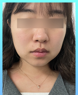 after 사진